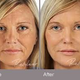 Illustration for article titled Make Use of Acne Scars Laser Resurfacingem/em